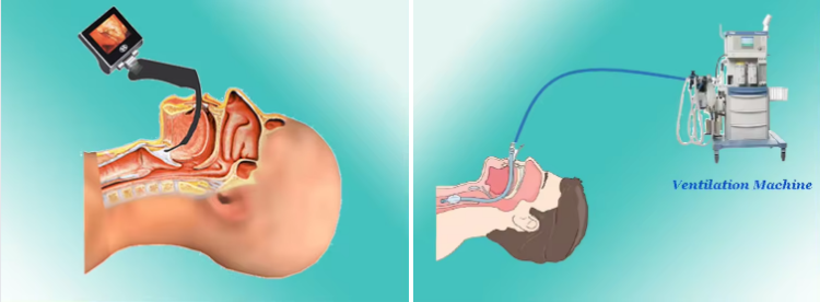 How_long_does_a_laryngoscopy_take_under_general_anesthesia.png