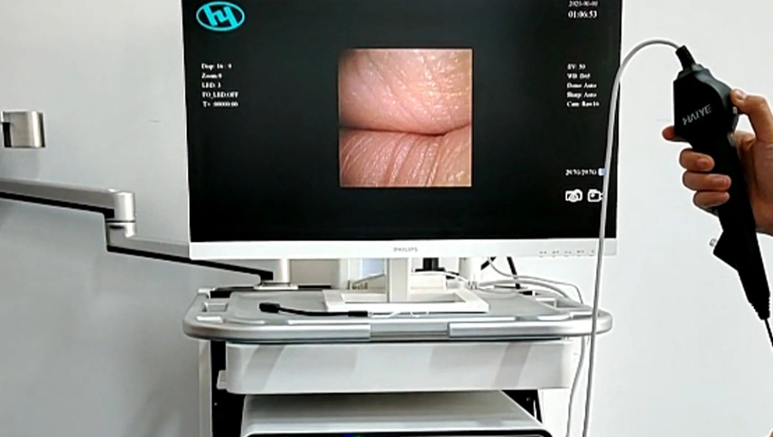 Disposable Ureteroscope+System